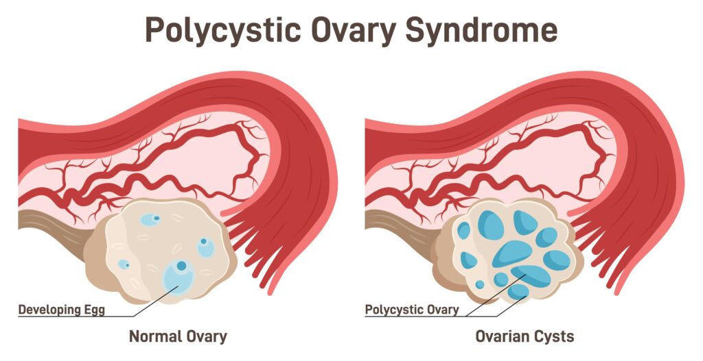 pcos
