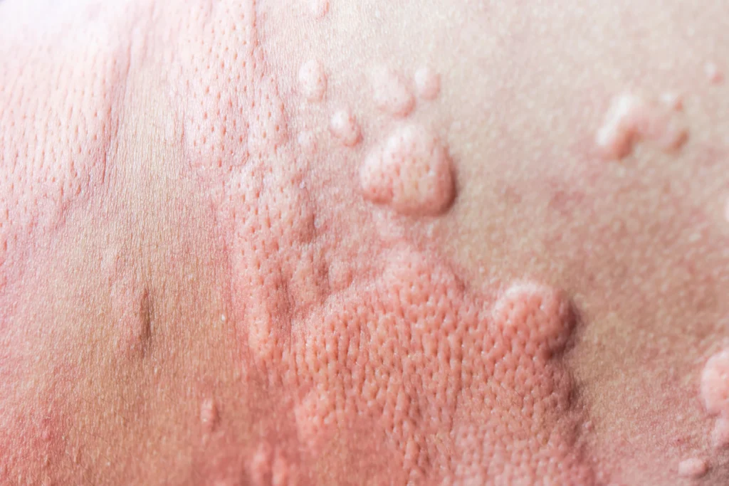 Demystifying MCAS: How Histamine Impacts Pathophysiology 1